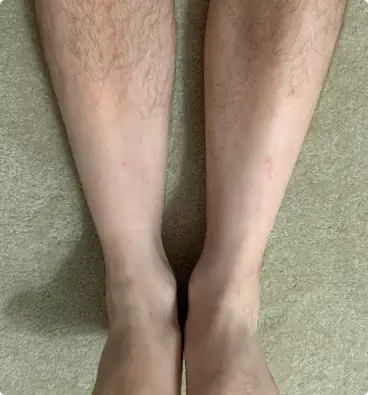 Hair Loss in Legs