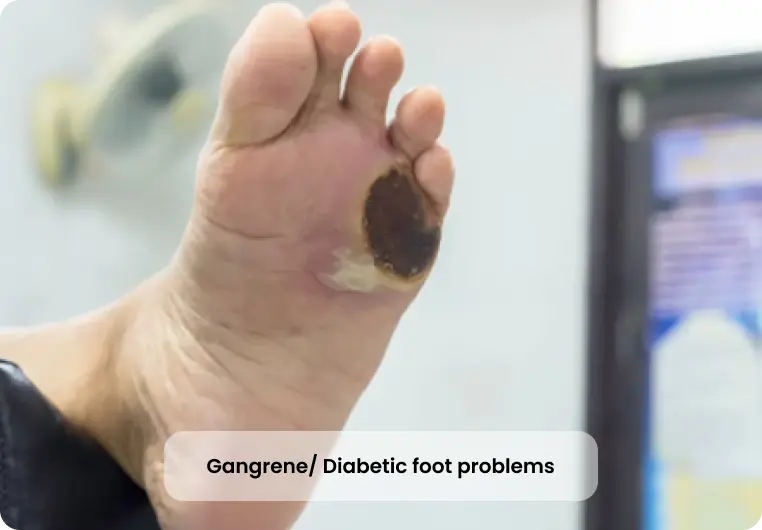 diabetic-foot-problems-img