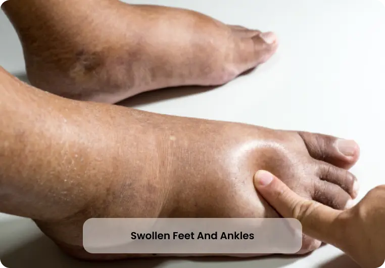 swollen-foot-and-ankles-img