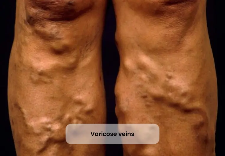 varicose-veins-img-new