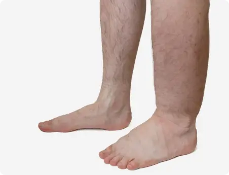 leg-swelling