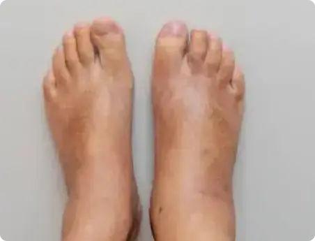 swollen-feet
