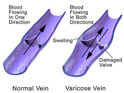 Varicose Veins