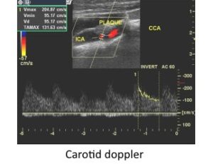 Carotid Doppler