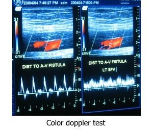 Color Doppler Test