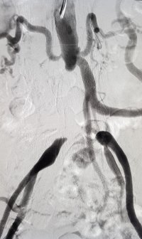 Digital Subtraction Angiography