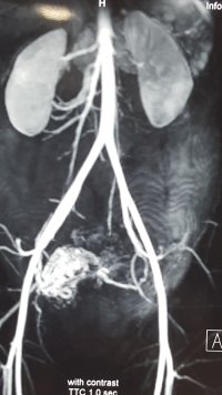 MRI Angiography