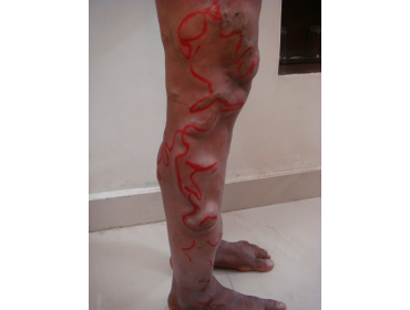 vascular malformation of leg