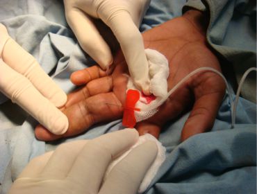Hand vascular malformation sclerotherapy