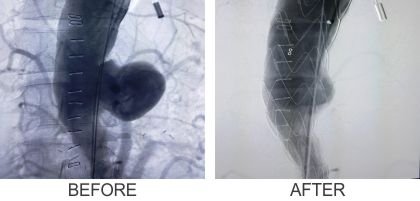 Endovascular Treatments (Before & After)
