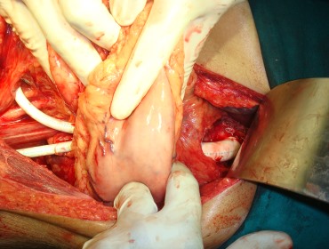 Supra celiac Aorto femoral bypass to prevent leg amputation