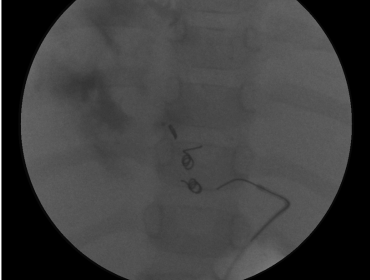 Hepatic aneurysm coiling