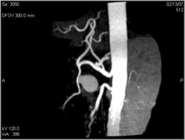 Mesenteric artery aneurysm