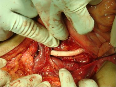 Mesenteric bypass