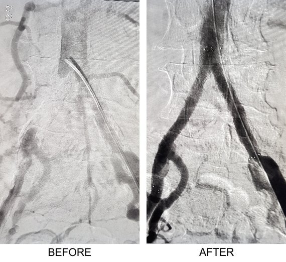 Peripheral Artery Disease (Before & After)
