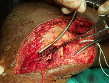 Popliteal artery injury repair