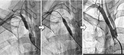 Subclavian Stenosis (Before & After)