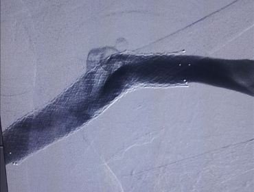 Subclavian vein stent