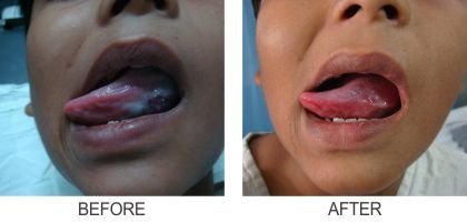 Vascular Malformation Tongue Pre Post