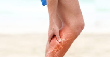 Varicose Veins Treatment
