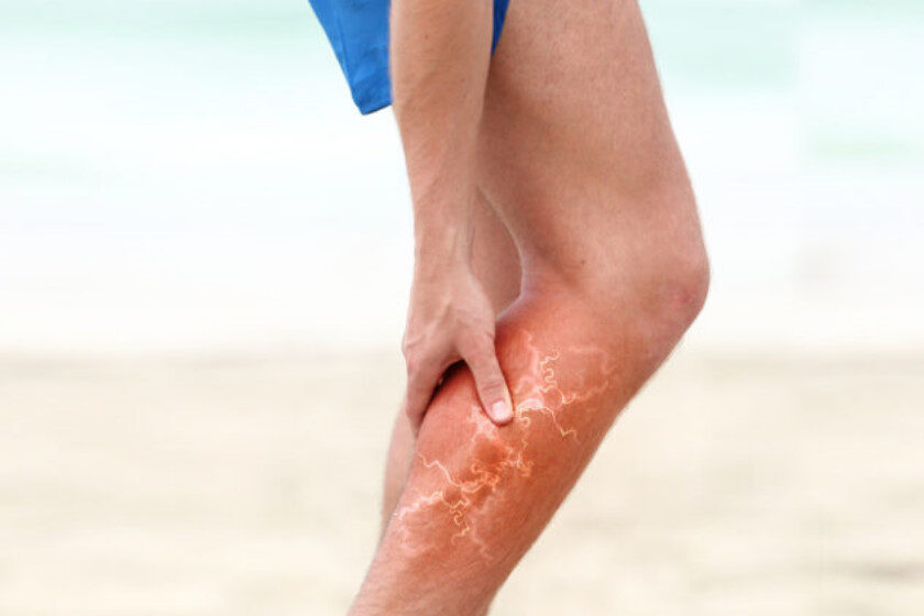 Varicose Veins Treatment