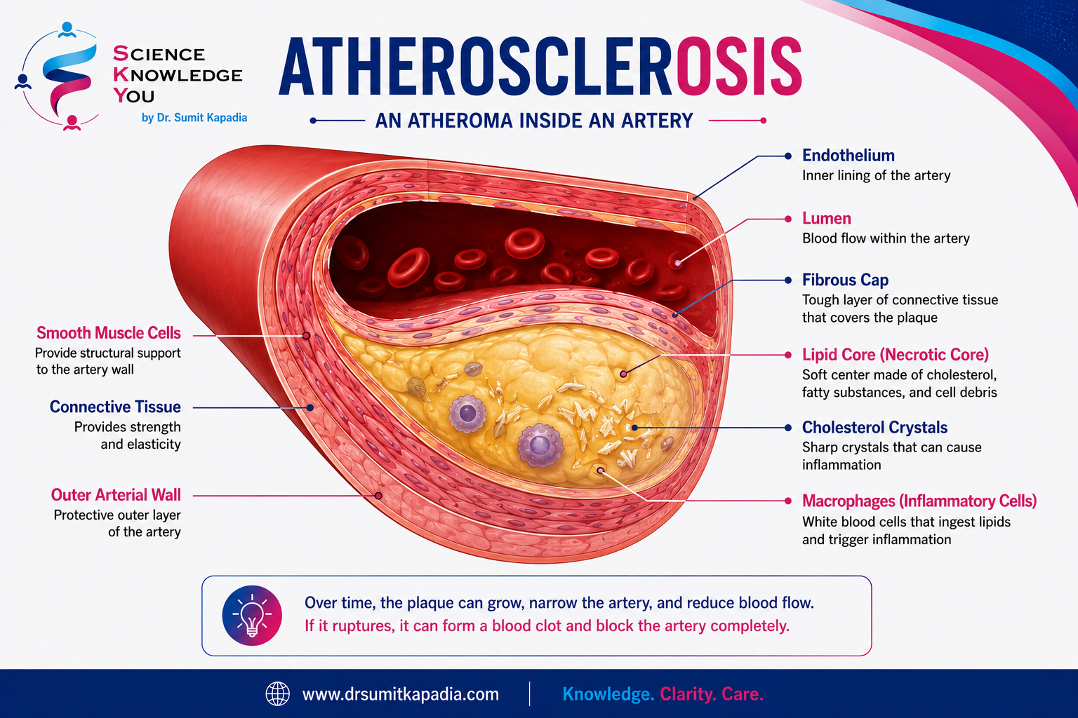 What Is Atherosclerosis?