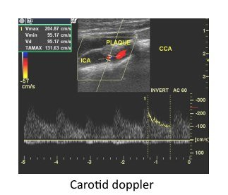 Carotid Doppler