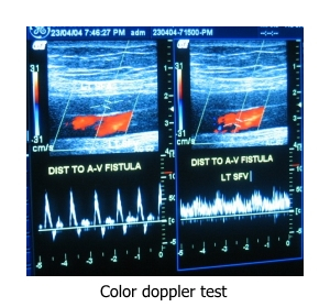 Color Doppler Test