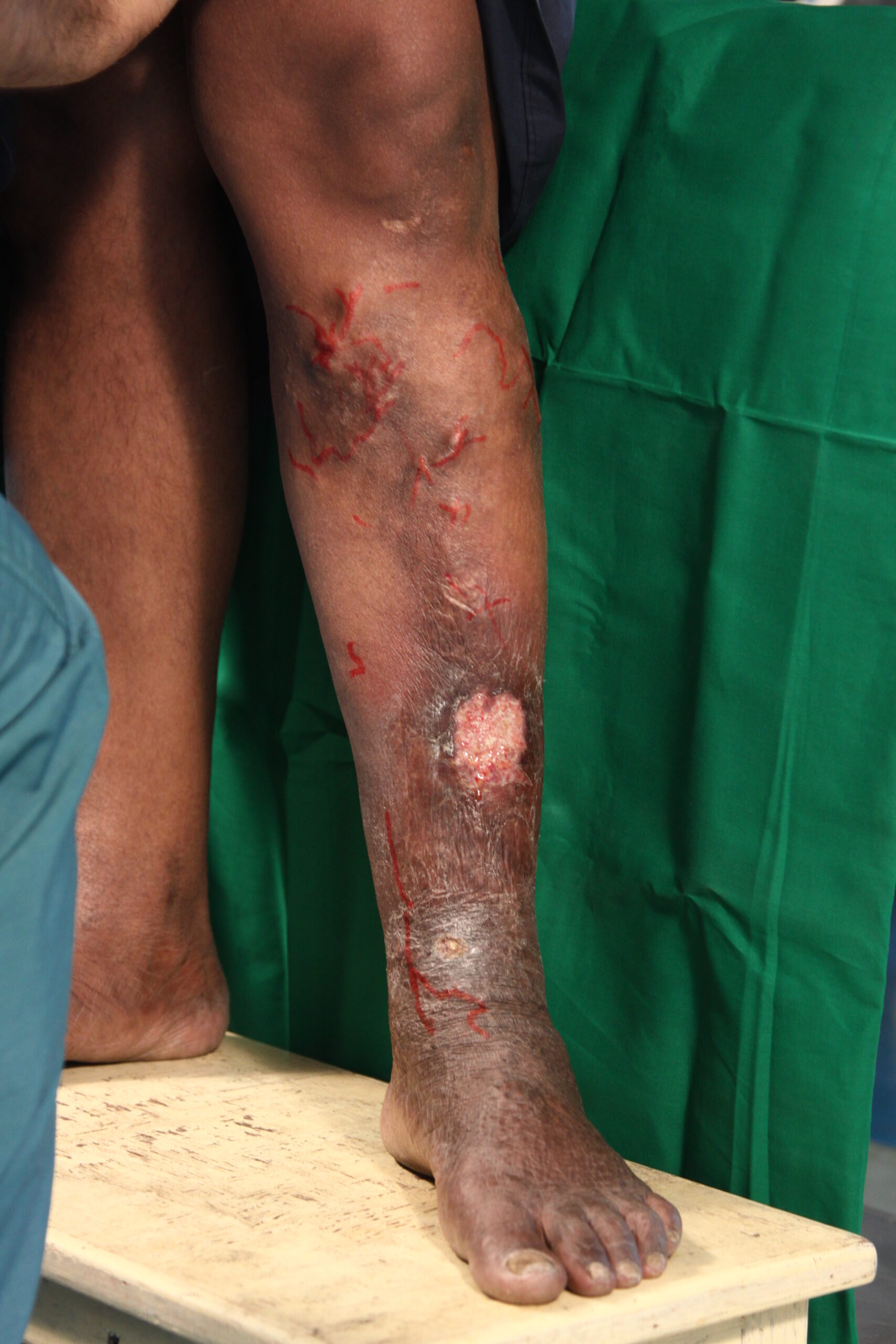 Before treatment
