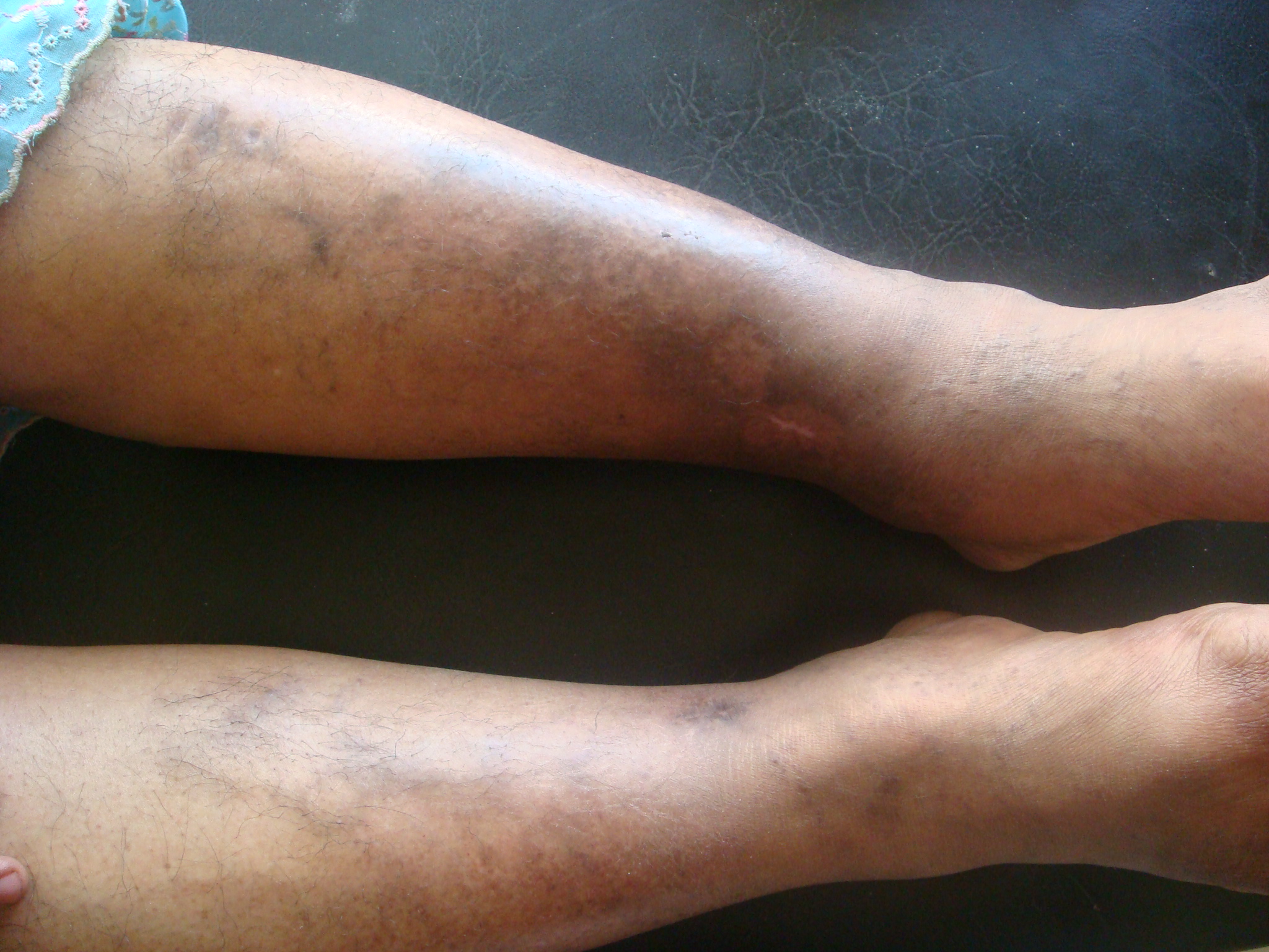 Before treatment