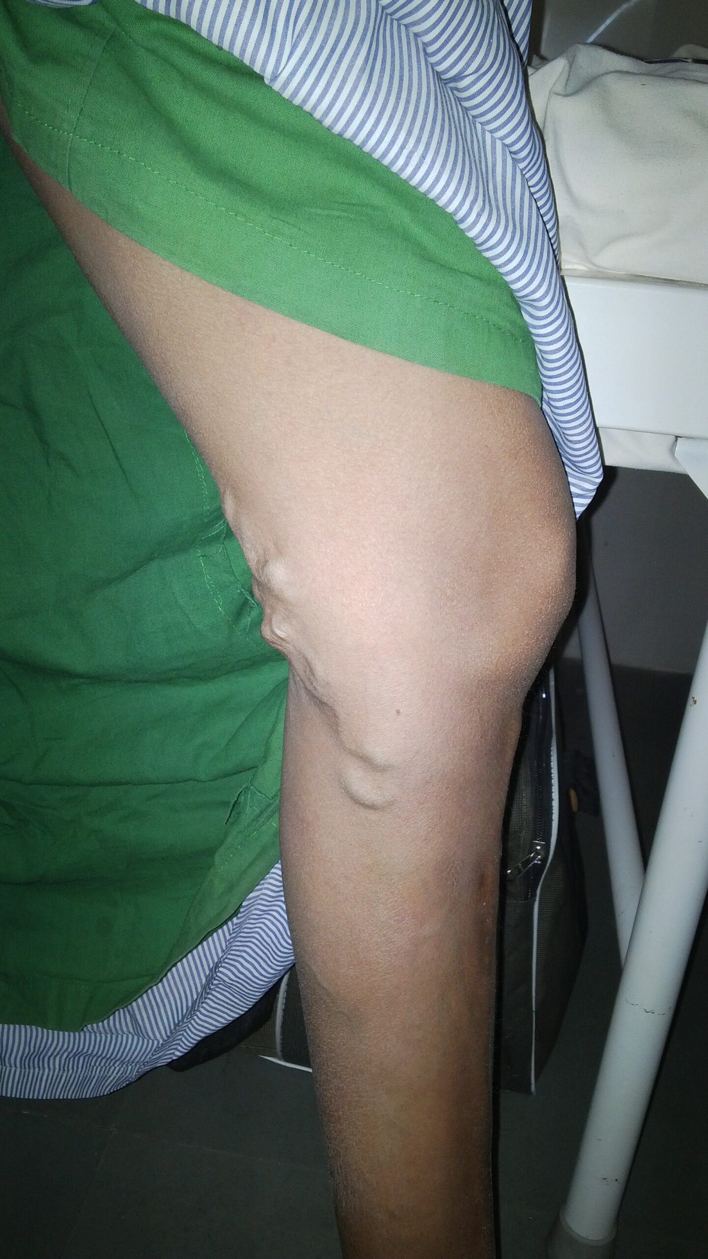 Before treatment
