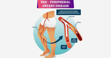 Peripheral Artery Disease