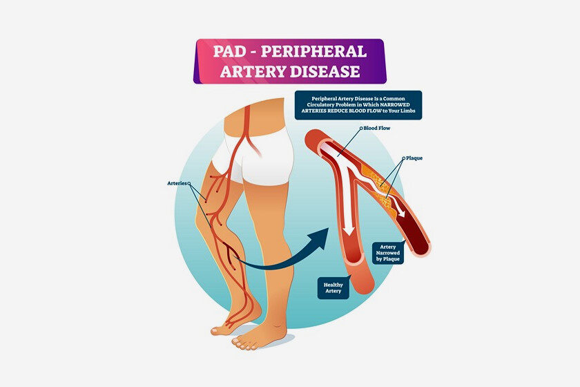 5 Things To Know About Peripheral Arterial Disease Pad