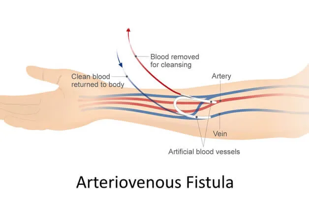 Arteriovenous Fistula