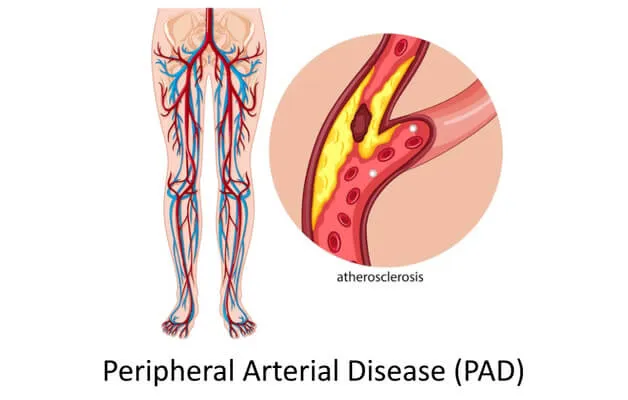 Peripheral Arterial Disease (PAD)