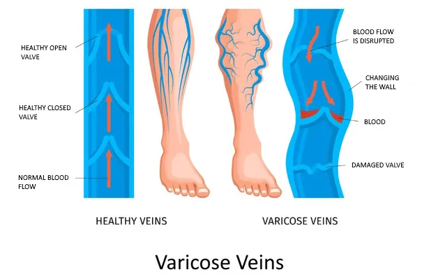 Varicose Veins