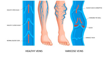 Varicose veins complication
