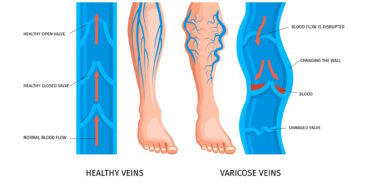varicose vein complications