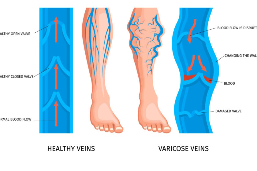 Varicose veins complication