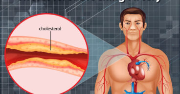 Diagram showing cholesterol blocking artery in human body illustration
