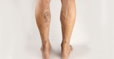 vascular-malformations