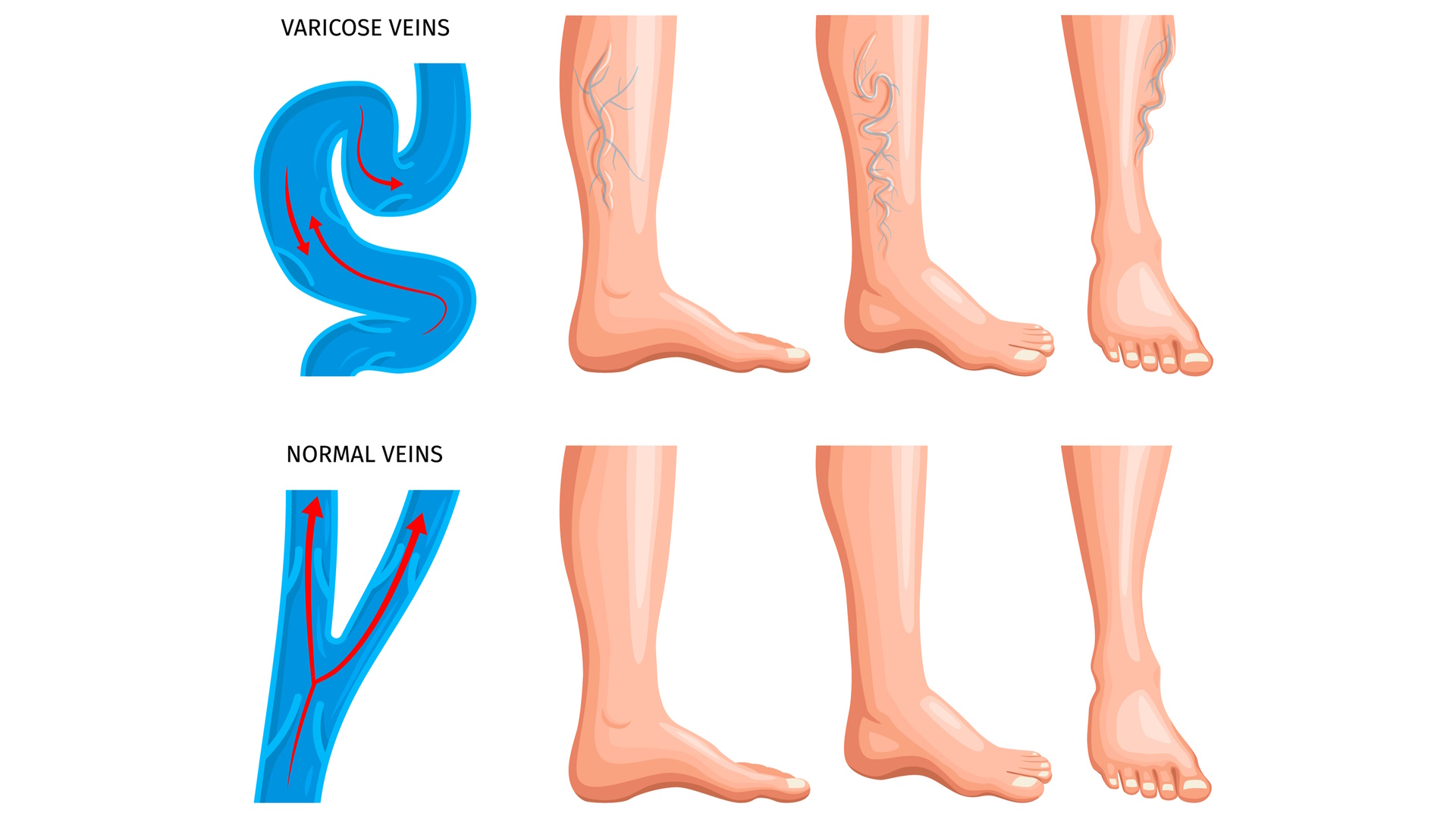 Varicose Veins: 7 Signs You Need to See a Vein Specialist