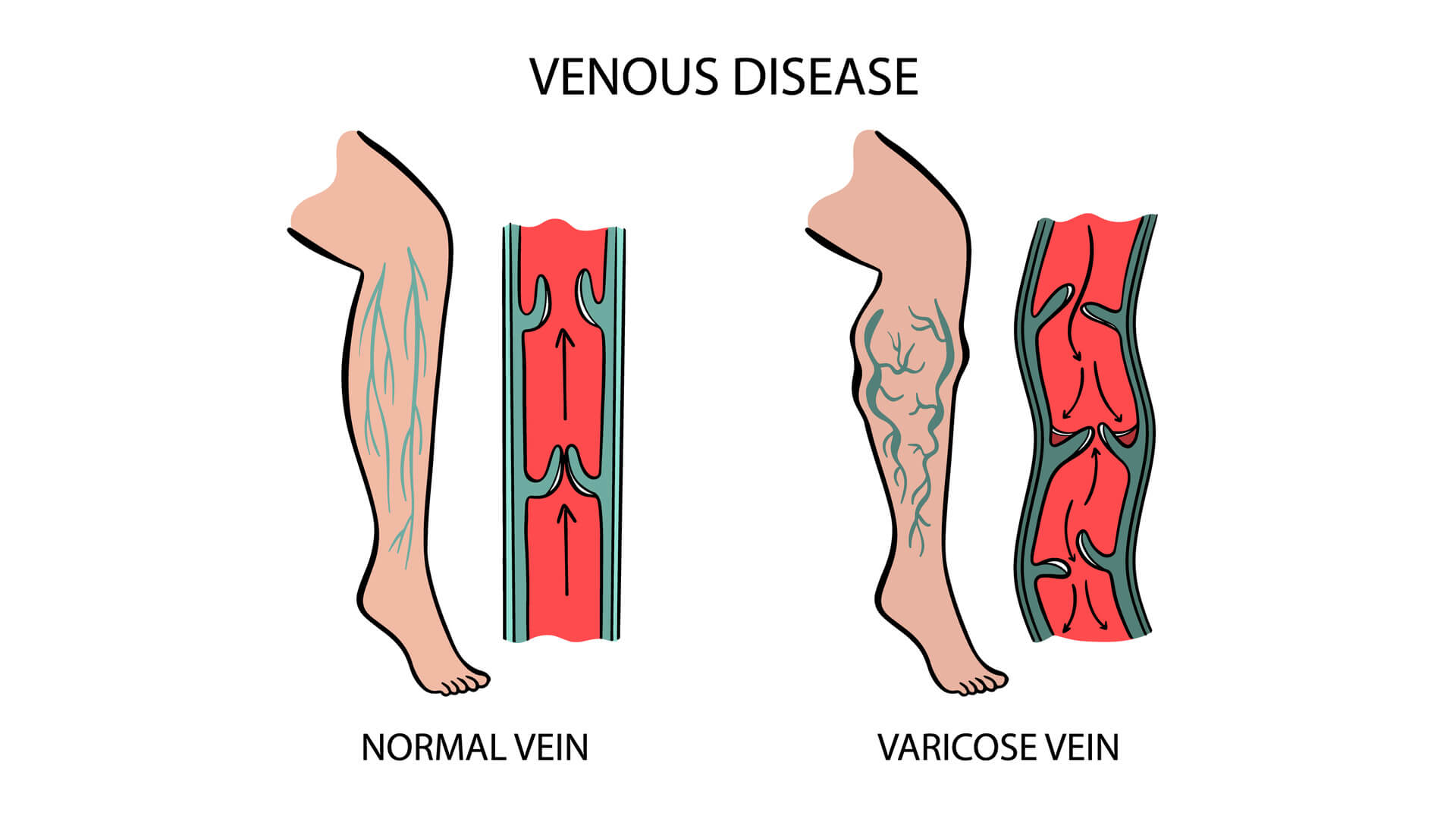 VenaSeal: Painless Varicose Vein Glue Treatment