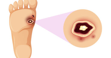 Diabetic Ulcer