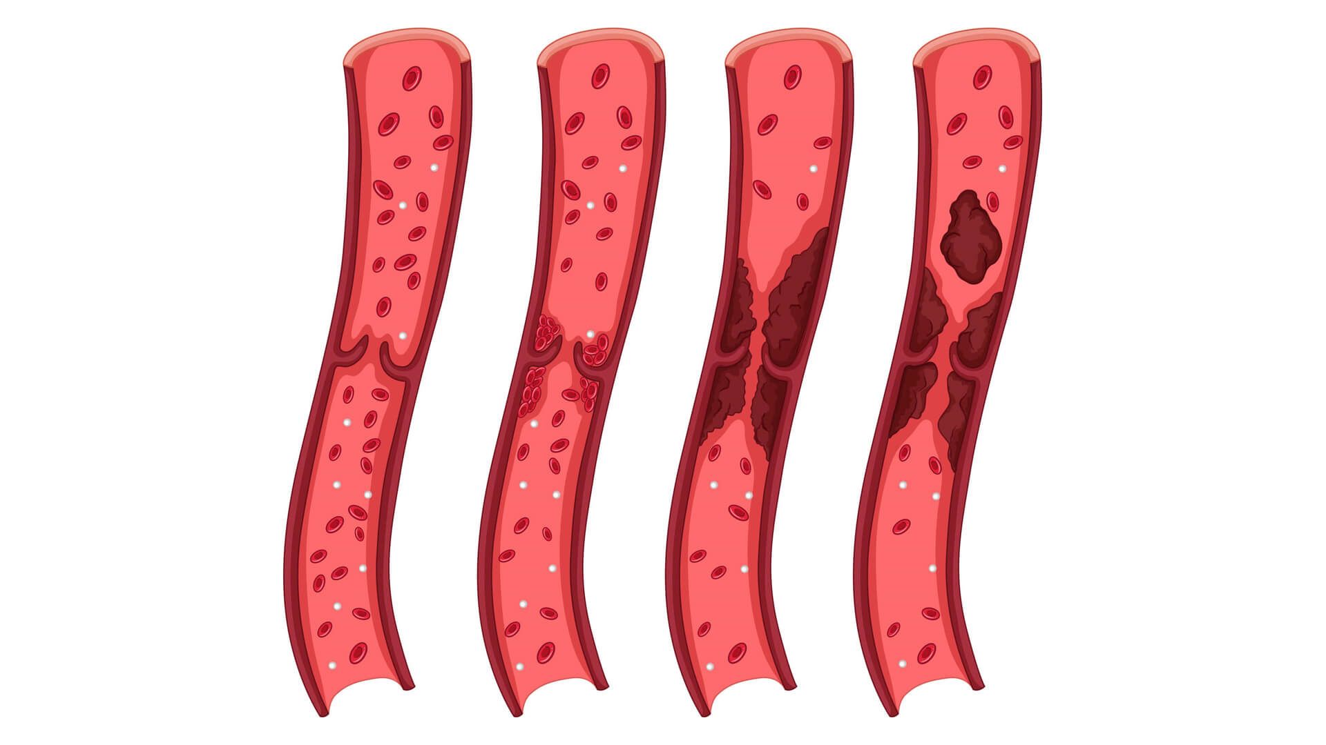 What are vascular disorders and how to deal with them?