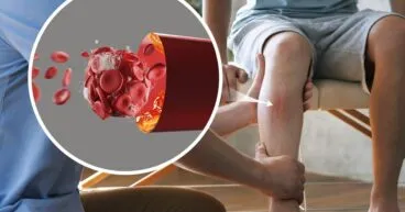 बाहरी धमनी की बीमारी