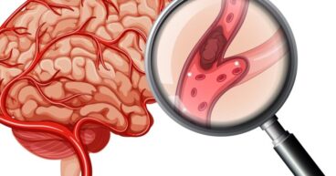 Endovascular-Treatment