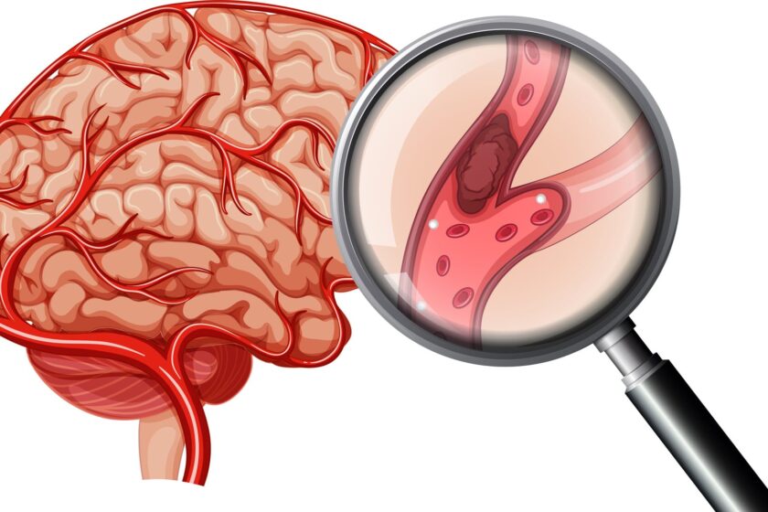 The Endovascular Treatment for Stroke – A Closer Look!
