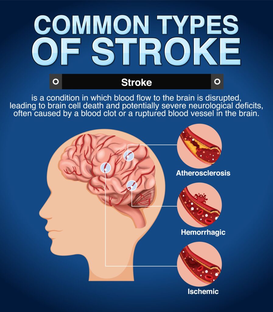 Endovascular Stroke Treatment Explained by Dr Sumit Kapadia