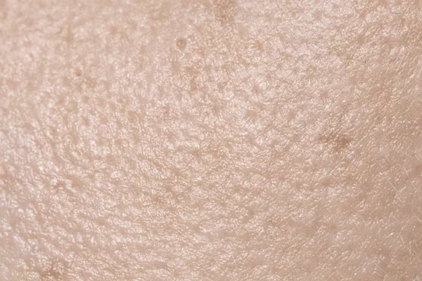 त्वचा की गहराई से परे: आपके संवहनी तंत्र पर वैरिकाज़ नसों के प्रभाव का अन्वेषण